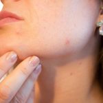 Tot ce trebuie sa stii despre ingrijirea tenului acneic